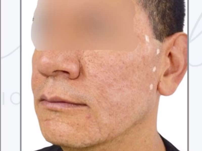 After Definición mandibular con hilos tensores
