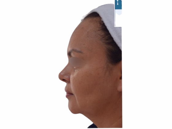 Before Tratamiento hilos tensores - Resultados reales antes y después