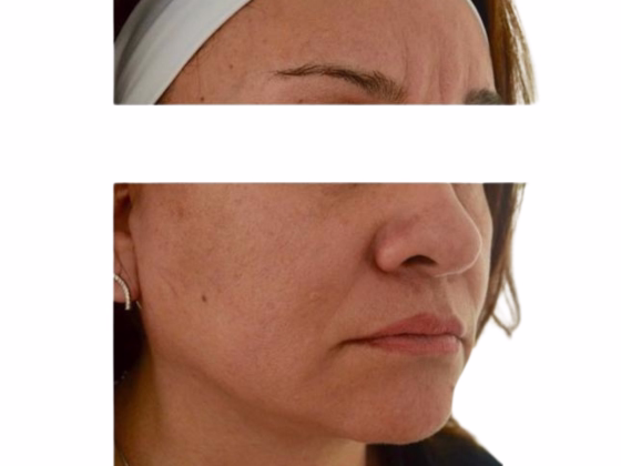Before Resultados hilos tensores antes y después - Lifting facial sin cirugía