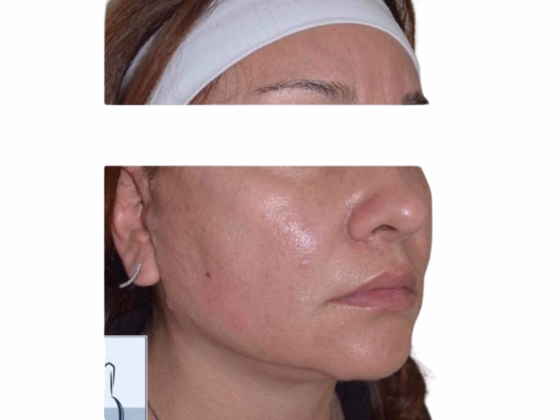After Resultados hilos tensores antes y después - Lifting facial sin cirugía