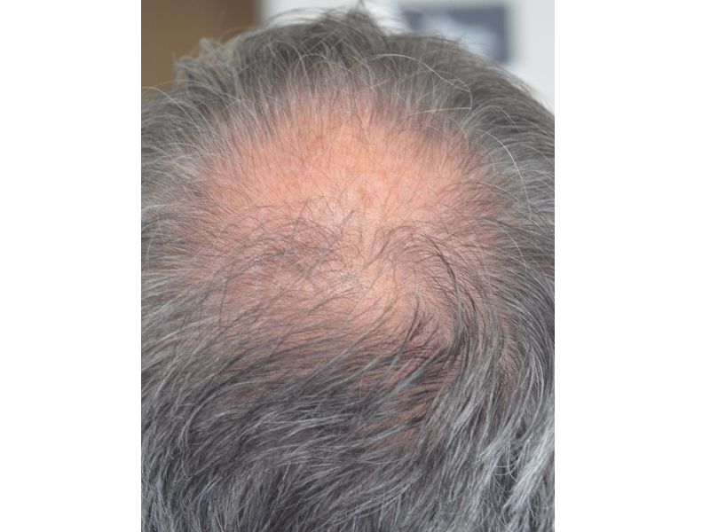  Before Regeneration with intradermal therapy 