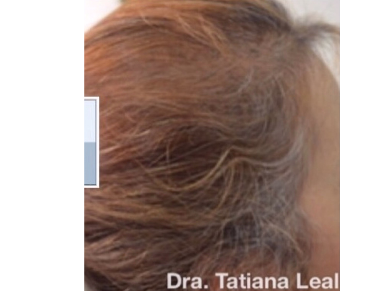 Después del Recuperación capilar a cliente