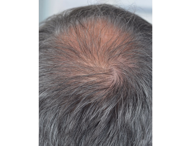 After Regeneration with intradermal therapy