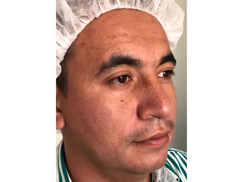  Antes del Tratamiento de manchas solares 