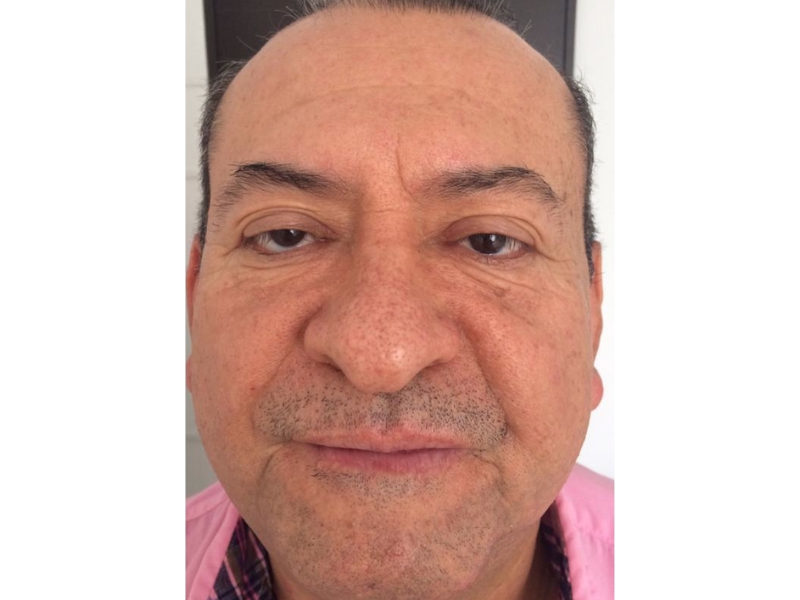  Antes del Rejuvenecimiento facial completo 