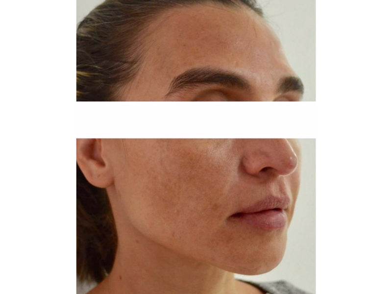  Antes del Reducción de cicatrices 