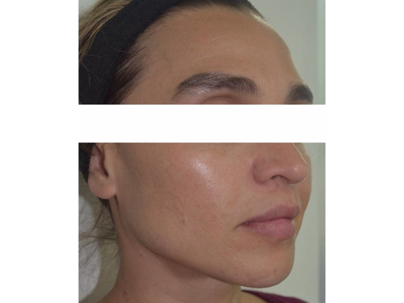 Después del Reducción de cicatrices