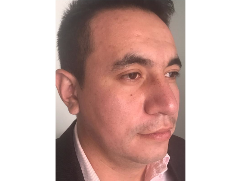 Después del Tratamiento de manchas solares