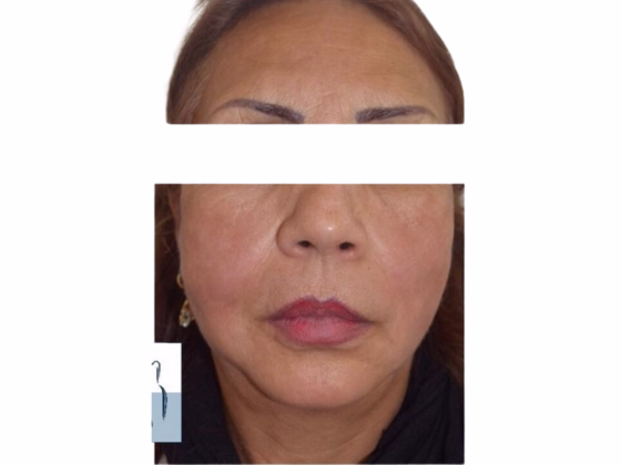 After Resultados lifting facial con hilos tensores - Bogotá