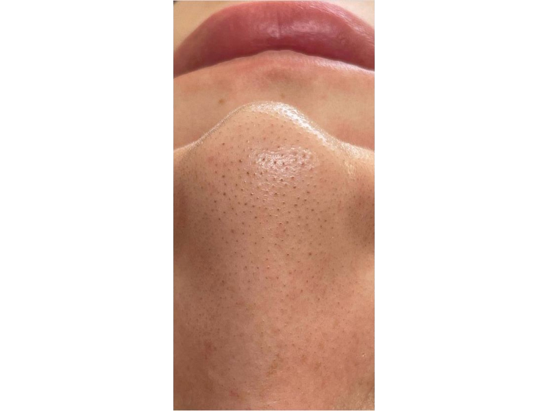  Antes del Piel grasa y obstrucción de poros 