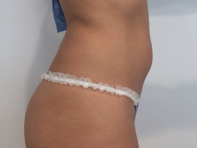 Before Reducción abdominal