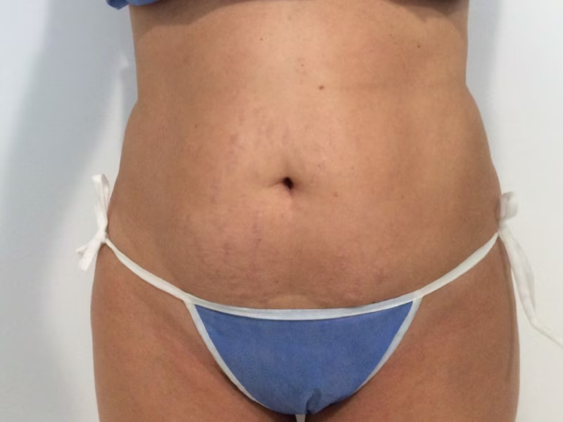 Before Contorno corporal