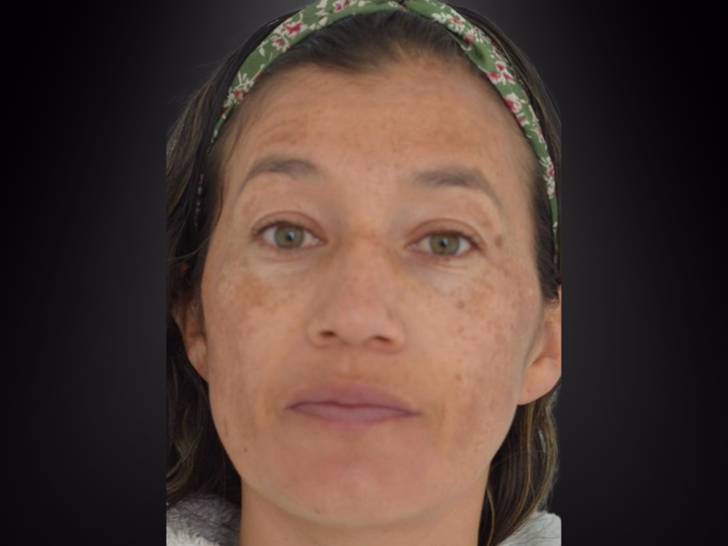  Before Professional treatment for sunspots 