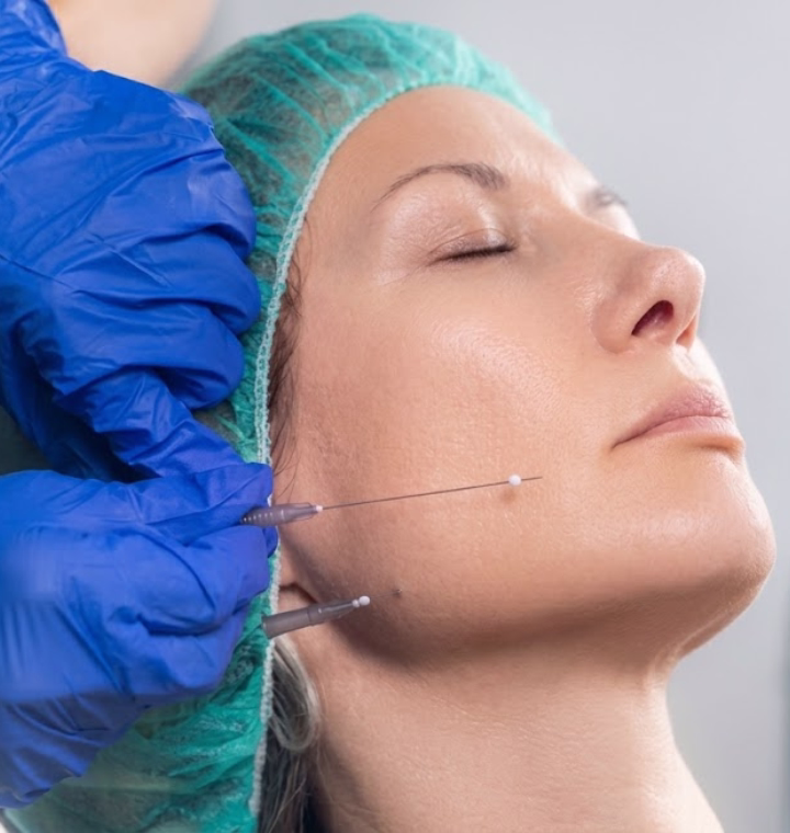 Facial sagging treatment with absorbable PDO thread lift in Bogotá