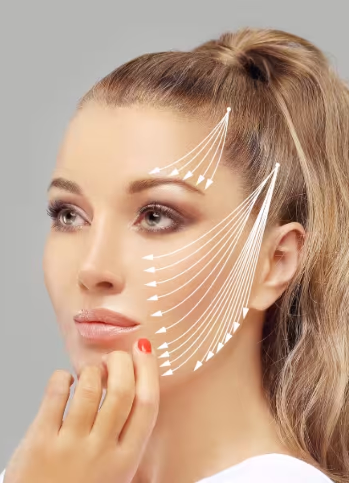PDO thread lift application with painless microcannula in Bogotá