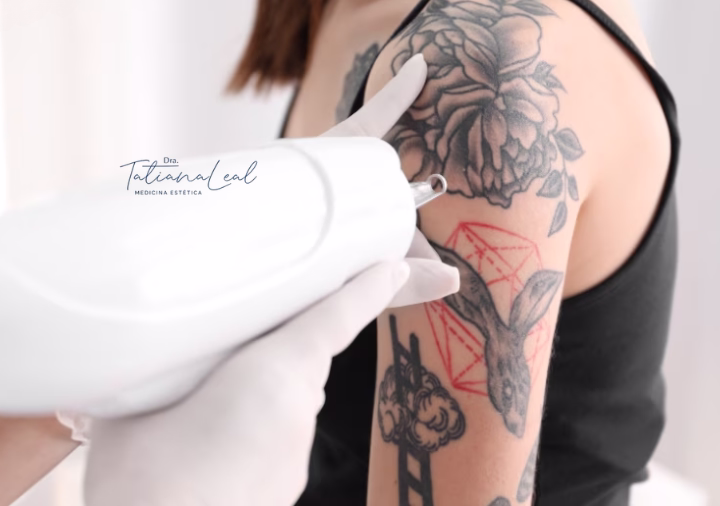Q-Switch COLORMAX laser technology for tattoo removal in Bogotá Q-Switch COLORMAX laser equipment for tattoo removal in Colombia