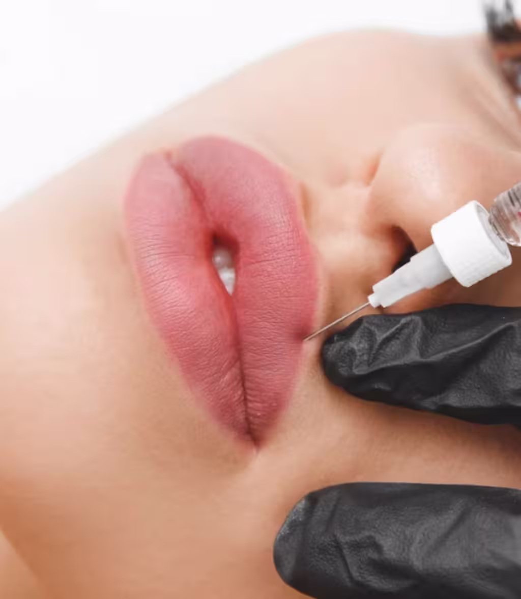 Aumento de labios natural por la Dra. Tatiana Leal - Resultados hermosos y seguros
