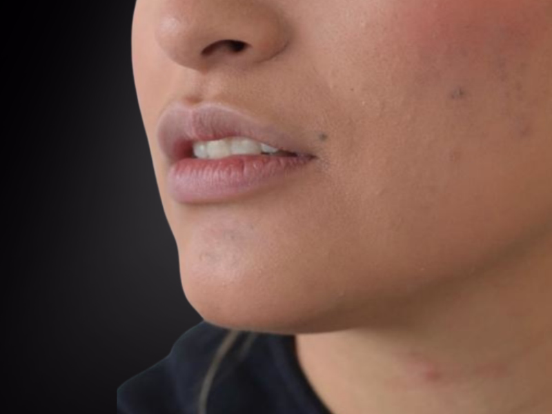 Before Natural lip contouring