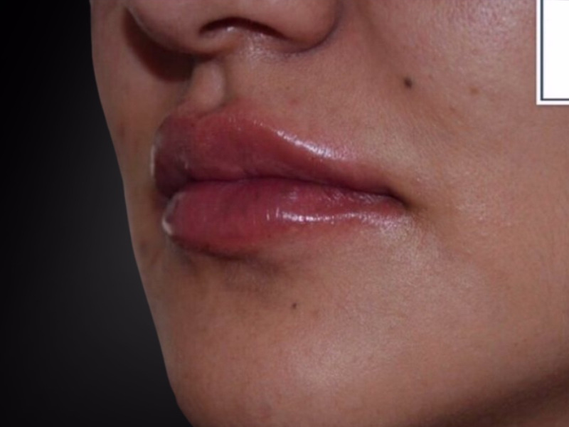 After Lip rejuvenation
