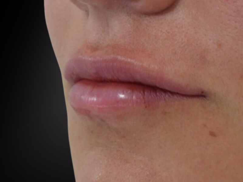 After Lip harmonization