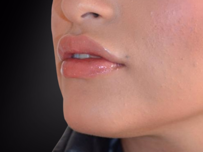 After Natural lip contouring