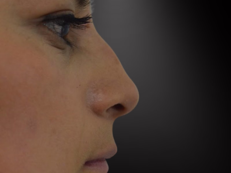Antes de la rinomodelación con ácido hialurónico: perfil nasal con giba visible y punta descendida