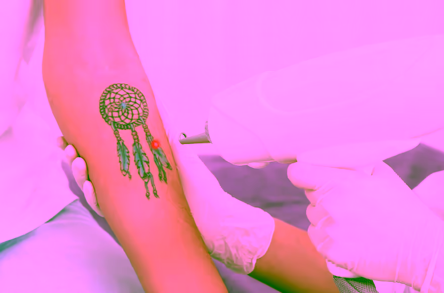 Dra. Tatiana Leal aplicando láser COLORMAX sobre un tatuaje durante el procedimiento en Bogotá