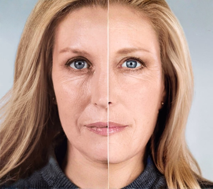Facial Sculptra before and after - natural rejuvenation Facial Sculptra before and after - natural rejuvenation