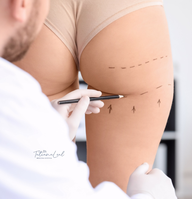 Sculptra butt lift protocol step by step for the buttocks