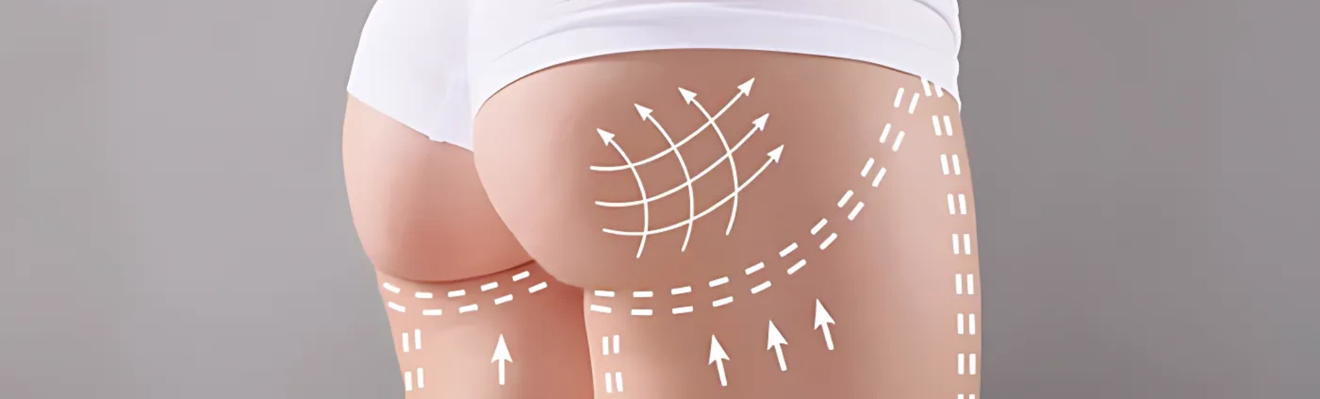 Sculptra for buttocks - natural enhancement without surgery performed by Dr. Tatiana Leal