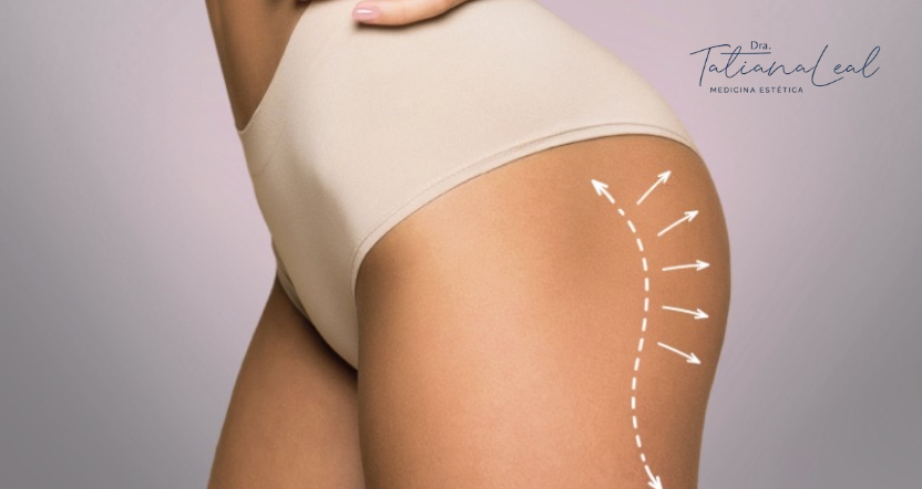 5-5-5 aftercare massage protocol following Sculptra on the buttocks