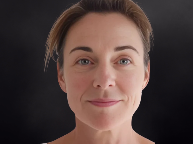 Después del Sculptra facial - Rejuvenecimiento natural