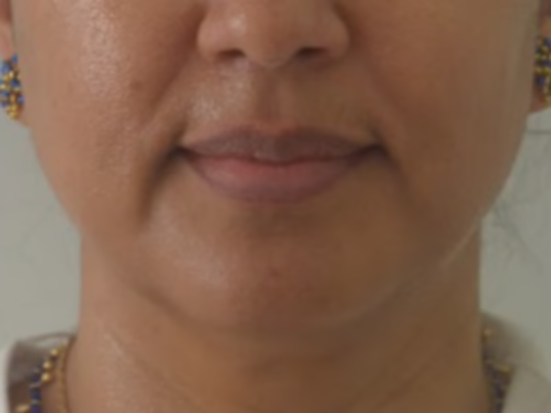  Antes del Sculptra en línea mandibular - recuperación de volumen 
