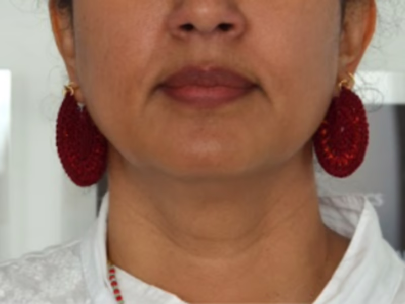 Después del Sculptra en línea mandibular - recuperación de volumen