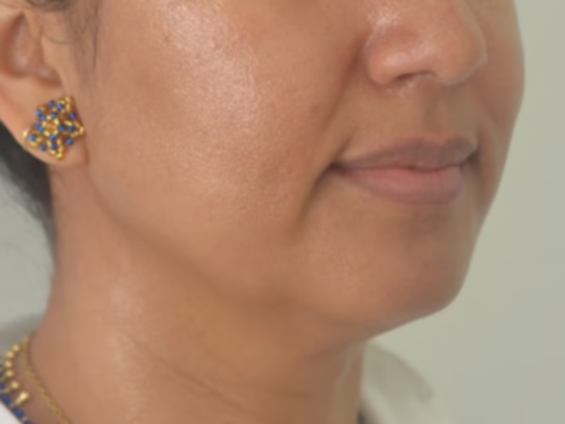  Antes del Sculptra perfil facial - contorno con colágeno 