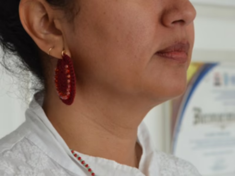 Después del Sculptra perfil facial - contorno con colágeno
