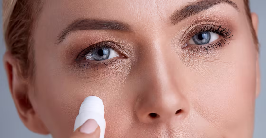 Close-up of the under-eye area to assess the type of dark circles before treatment in Bogotá