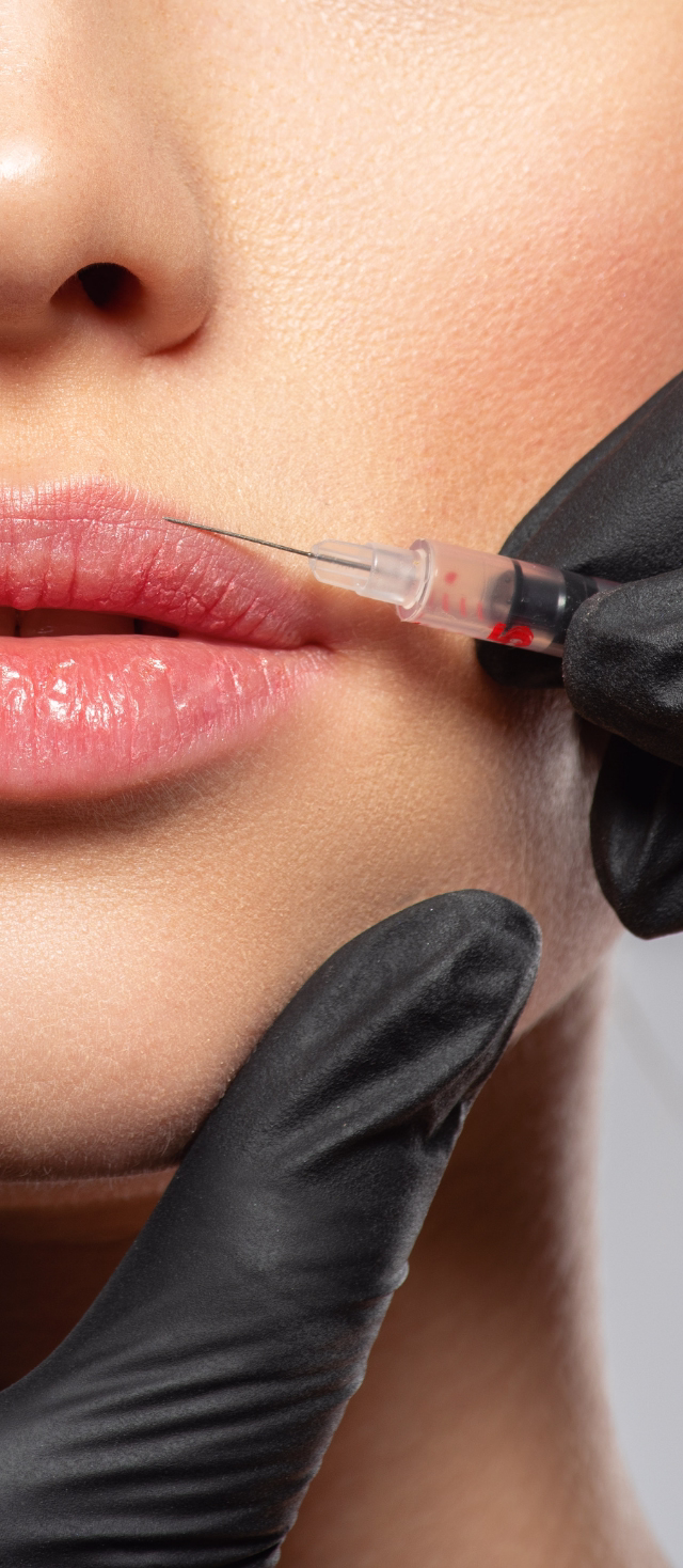 Tratamiento de código de barras con toxina botulínica aplicada por la Dra. Tatiana Leal en Bogotá