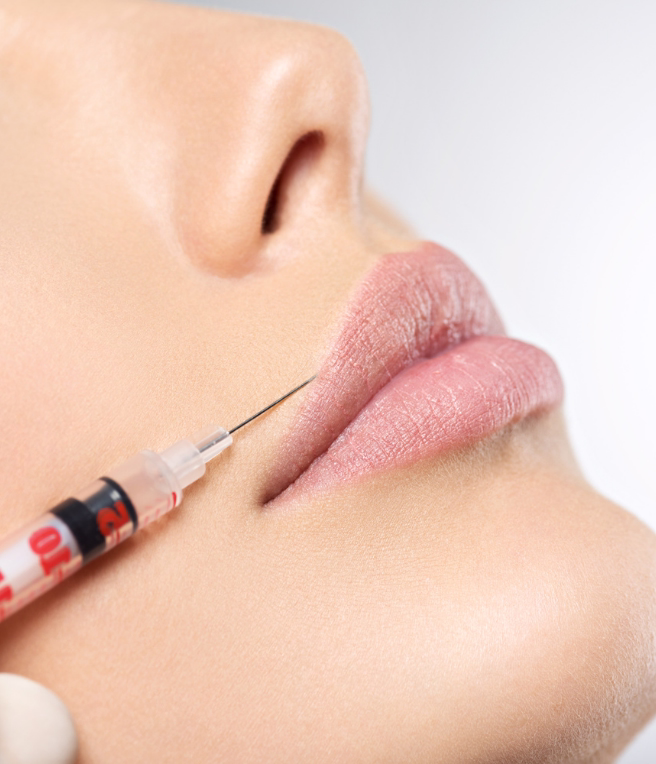 Resultados naturales de toxina botulínica en boca: suavización del código de barras sin perder expresión - Tratamiento en Bogotá