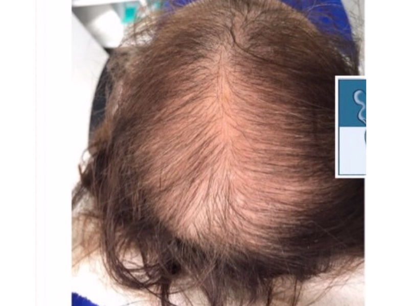  Before Hair recovery with PRP 