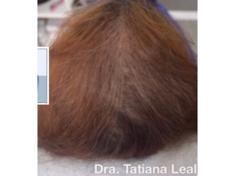 After Hair recovery with PRP