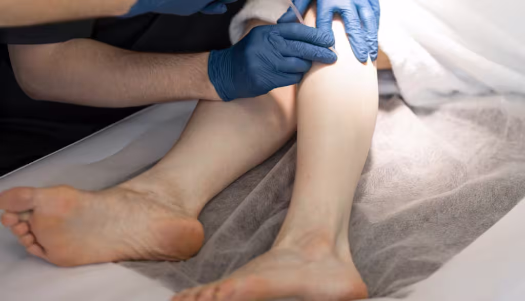 Varicose vein treatment with sclerotherapy performed by doctors