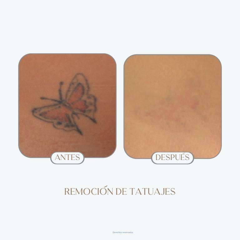 Dra Tatiana Leal remoción de tatuajes